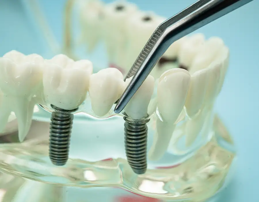 Зубные имплантаты - Стоматологическая практика в Брешии - Доктор Ирина Гараева