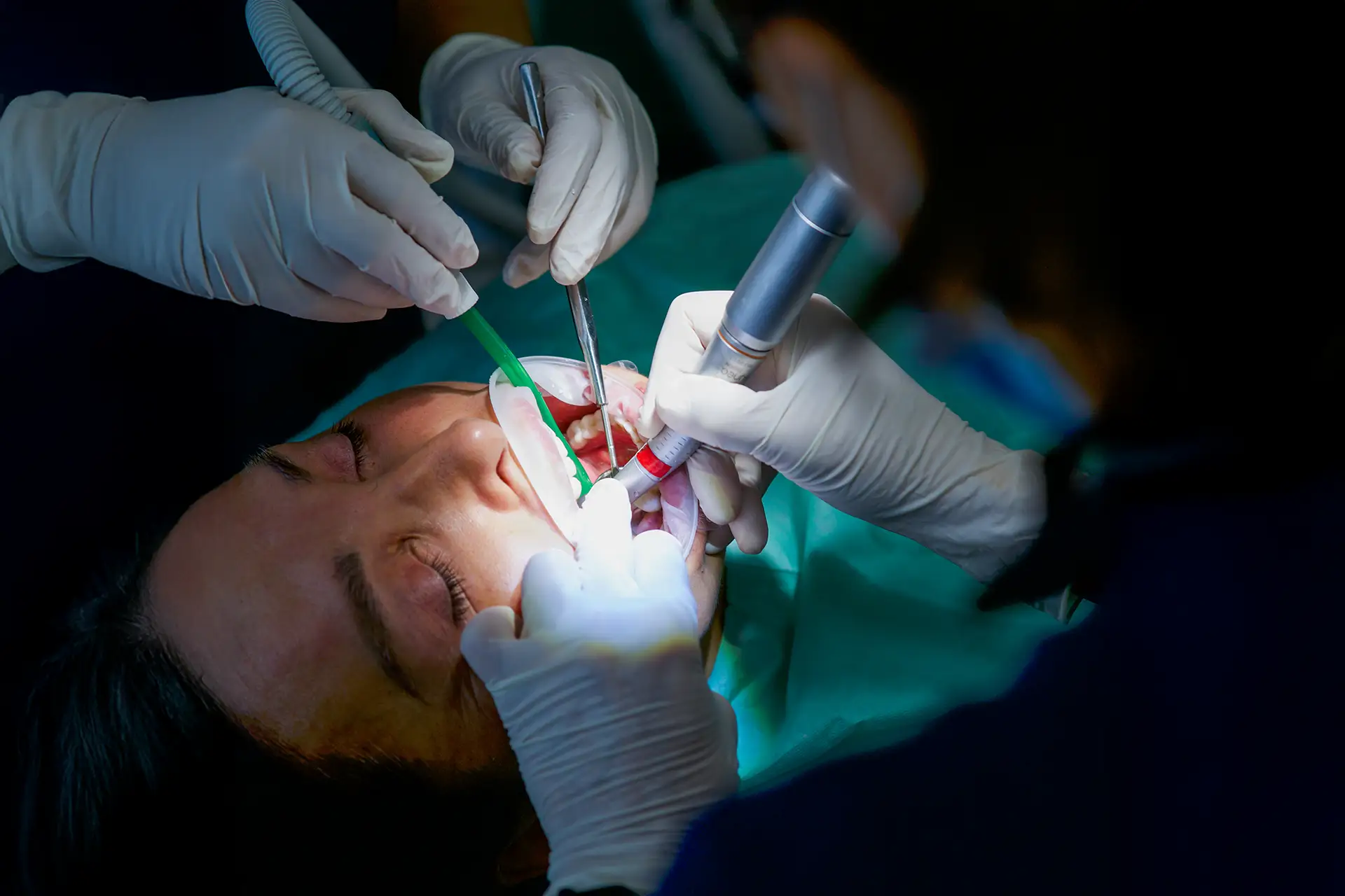 Chirurgia Orale - Studio dentistico a Brescia – Dott.ssa Irina Garaeva