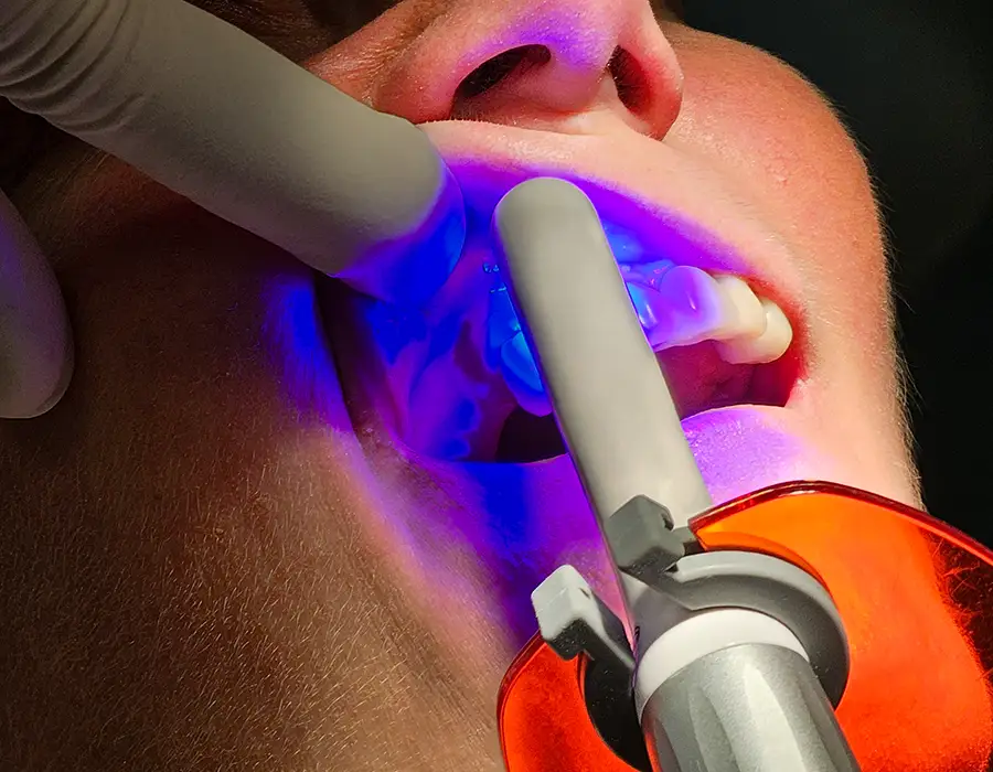 Профессиональное отбеливание зубов - Стоматологическая практика в Брешии - Доктор Ирина Гараева