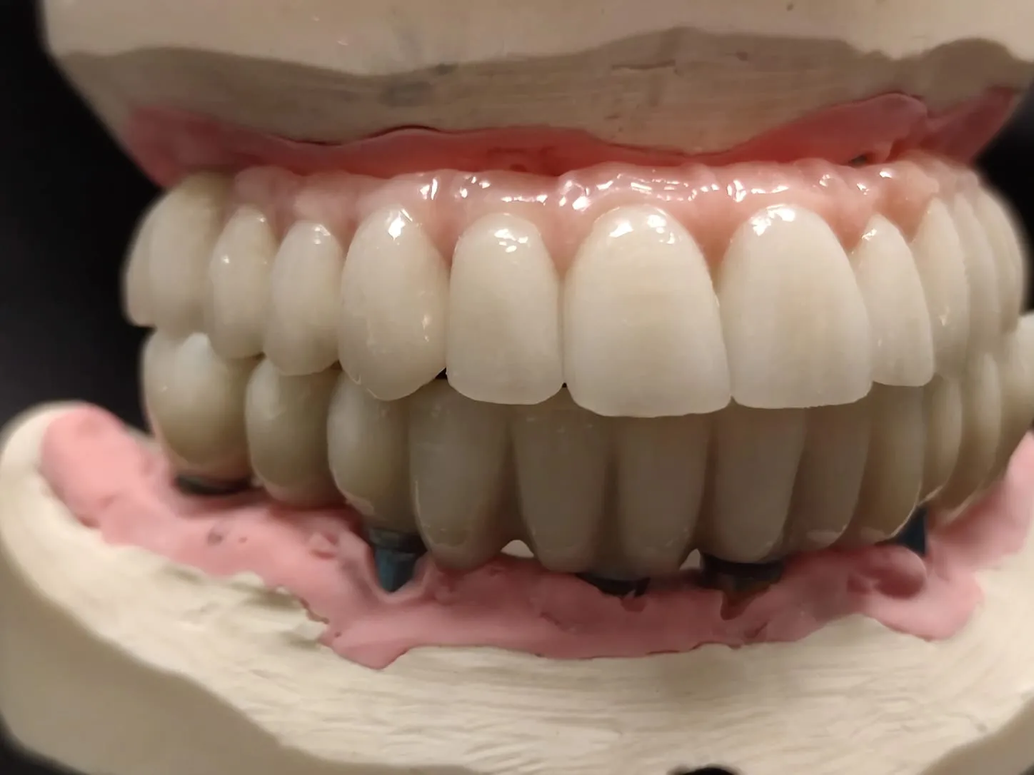 Технология винирования зубов - Стоматологическая практика в Брешии - доктор Ирина Гараева