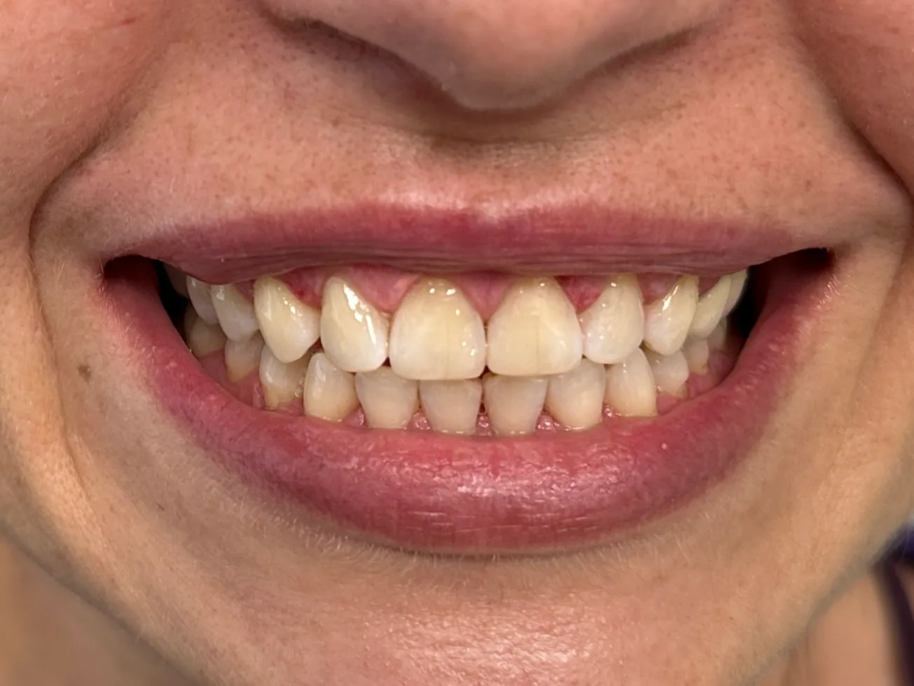 Почему стоит выбрать зубные виниры - Стоматологическая практика в Брешии - доктор Ирина Гараева