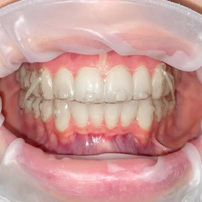 Невидимые альгеры - осознанный выбор - Стоматологическая практика в Брешии - доктор Ирина Гараева