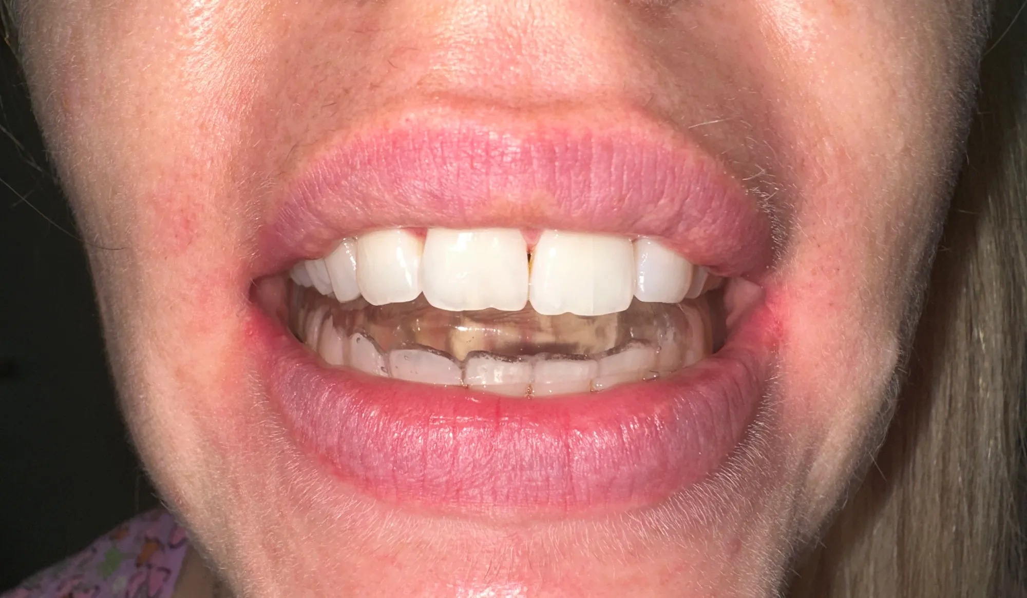 Гнатология - Стоматологическая практика в Брешии - доктор Ирина Гараева